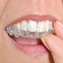 Invisalign (Invisible orthodontics) treatment